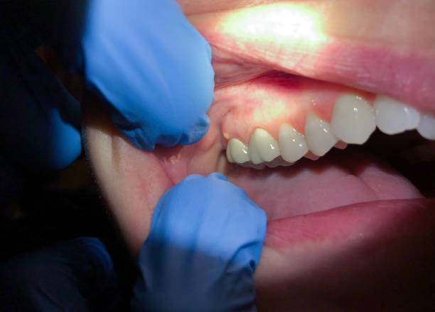 Best Dentist for Tooth Abscess  in Lebanon, TN
